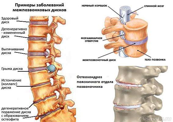 osteochondrosis och armén 