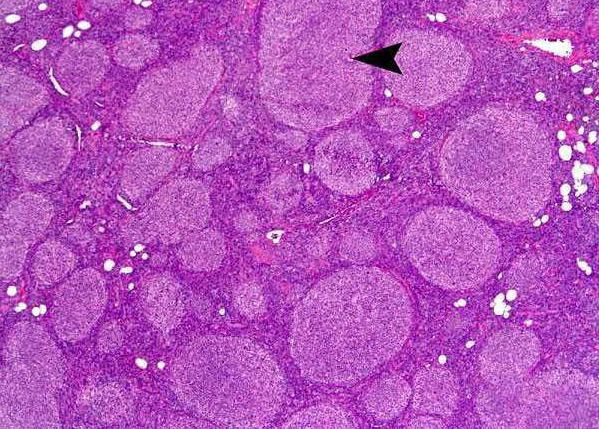 Follikulärt lymfom 3a av cytologisk typ