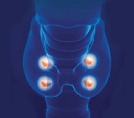 postoperativ hypoparathyroidism 