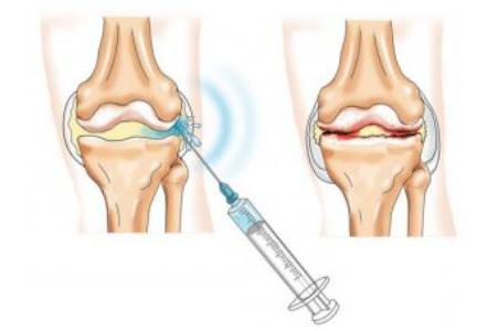 Osteoartrit symptom och behandling