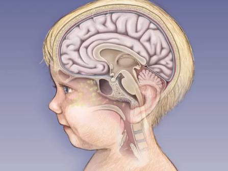 konsekvenser av hjärnhinneinflammation hos barn 