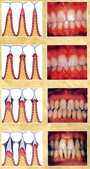 symtom på periodontit