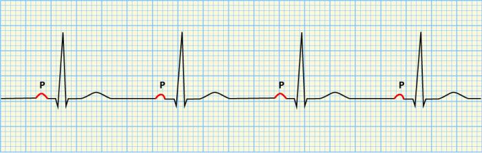 Syndrom förkortat PQ: orsaker, symptom, behandling