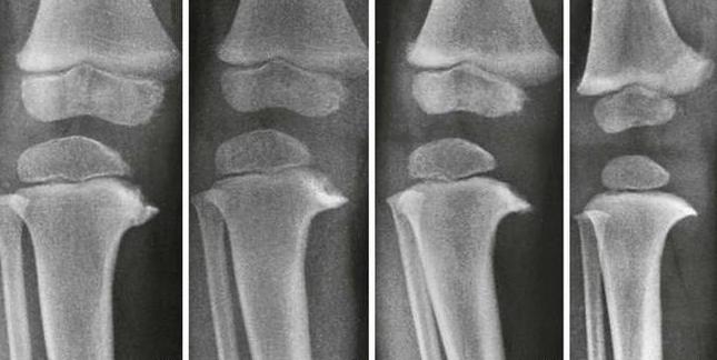 spondyloepiphysar dysplasi i extremiteterna