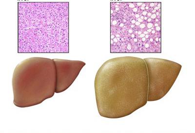 statohepatos symptom