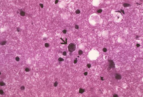 toxoplasmosis norm av test under graviditet