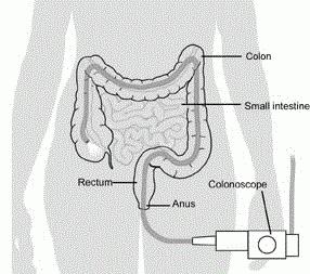 Virtuell koloskopi av tarmarna: recensioner och procedurbeskrivning