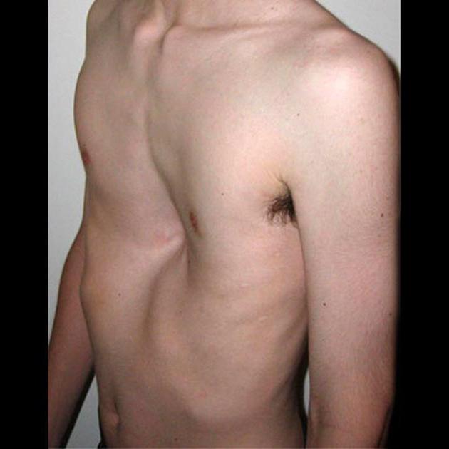 Tunnelformad deformation av bröstet: Funktioner av förekomst och konsekvenser
