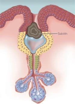 Spytkörtelns inflammation: symtom och behandlingar